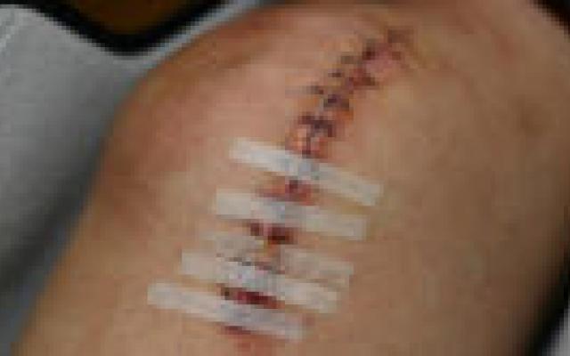 Geen toegevoegde waarde vroeg opereren voorste kruisband