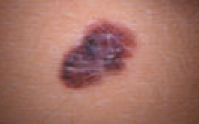 Diagnose door huidkanker-apps niet betrouwbaar