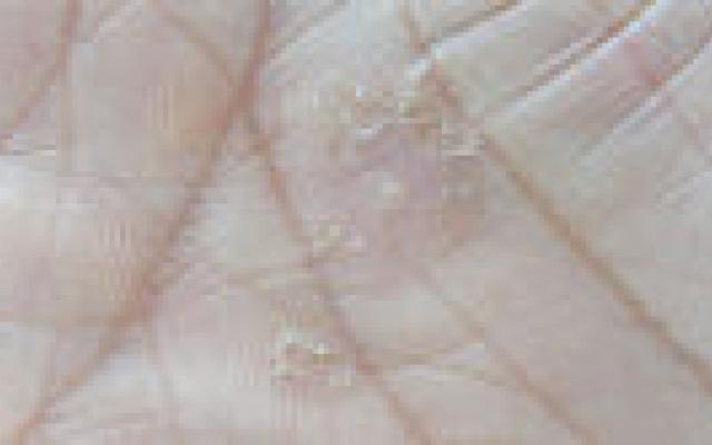 Stijging prevalentie psoriasis in Noorwegen