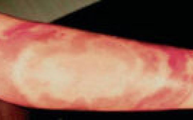 Terugkerende erythema migrans is nieuwe infectie