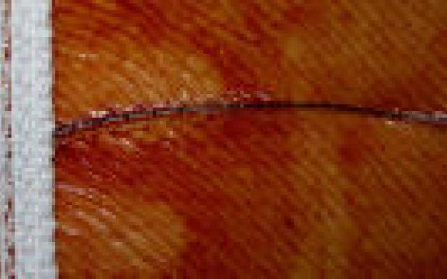 Ruggenprik vaker succesvol door echo