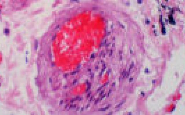 Steroïden verhogen tromboserisico