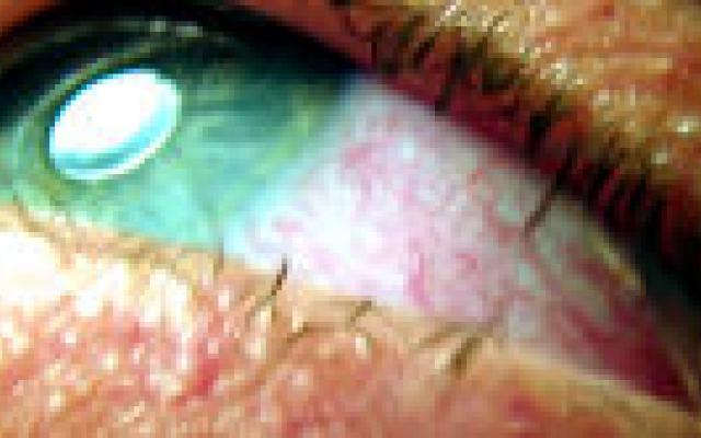 Snelle verslavingstest niet bruikbaar voor screenen op wietverslaving