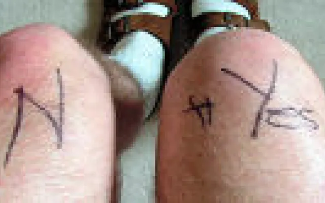 Kijkoperatie bij artrose van de knie: wat vindt de chirurg?