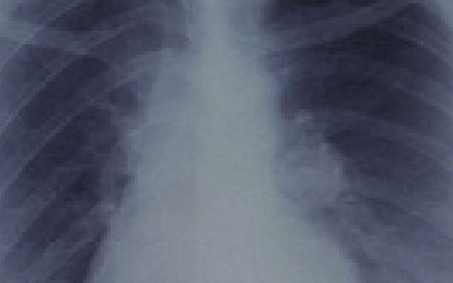 Verhoogde kans op embolie bij longkanker