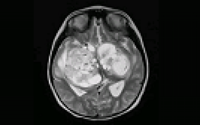 Hersentumor grotere impact op naasten van patiënt