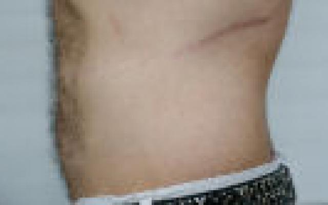 Uitstekende kwaliteit van leven voor oudere nierdonoren