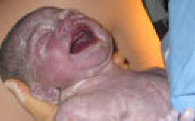 Inleiding van bevalling vergroot kans op sectio niet