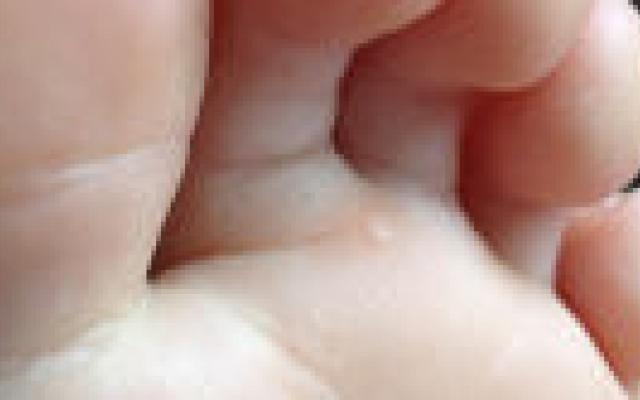 Grootste deel wratten verdwijnt vanzelf