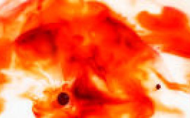 Ook jaren na een SAB nog PTSS