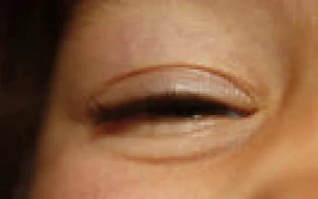 Snelle schifting tussen bacteriële en virale conjunctivitis