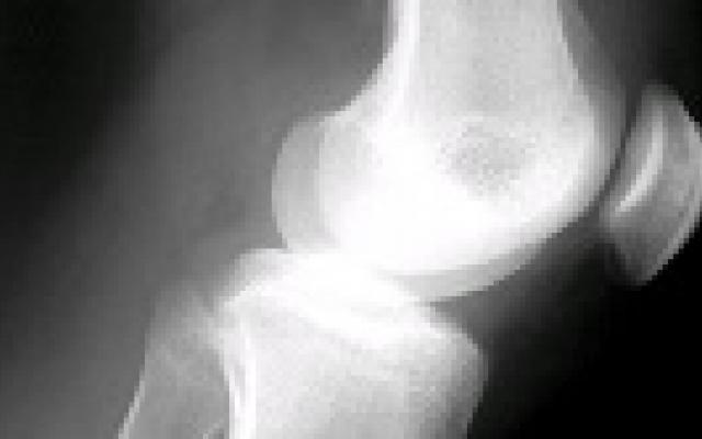 Operatie voor degeneratief meniscusletsel verder in diskrediet