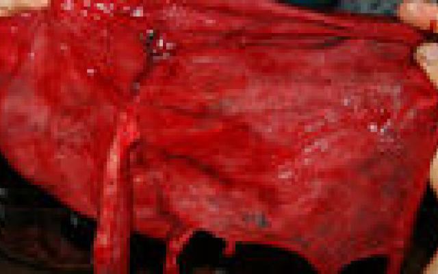 Kanker overgedragen van moeder op kind