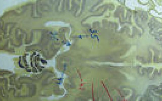 Hersenstimulatie werkt ook tegen tourettetics