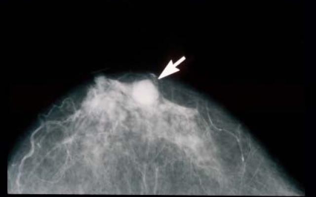 Borstkankerscreening in VS blijft onveranderd