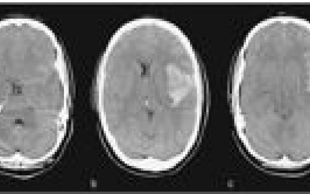 Occlusie aneurysma niet geïndiceerd bij alle ouderen 