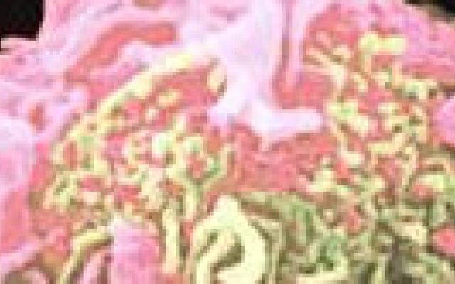 Cladribine effectief bij multiple sclerose