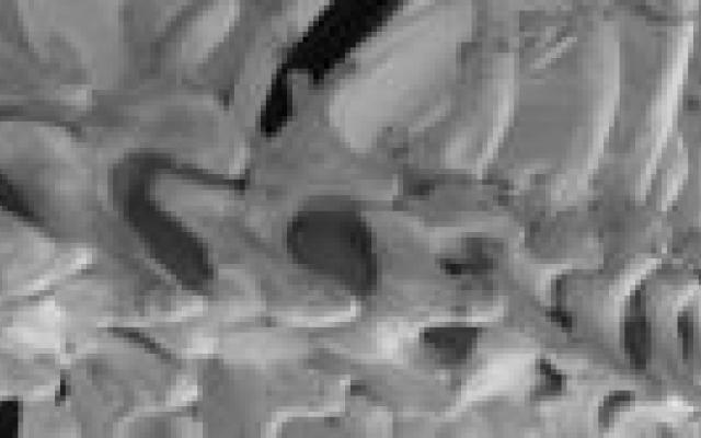 Osteoporosecheck in Brabant