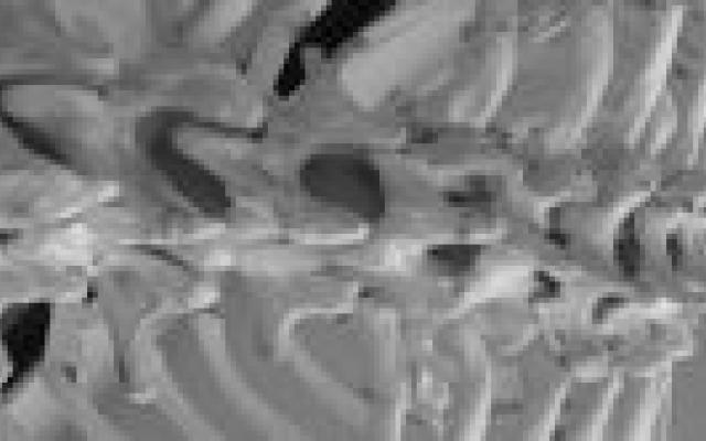 Anorexiapatiënten hebben meer beenmergvet