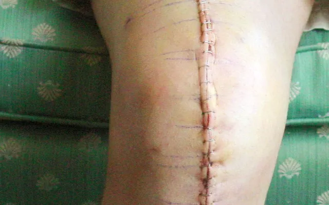 Zwaarder na nieuwe knie