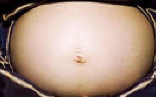 Geen relatie HPV-vaccinatie en miskraam