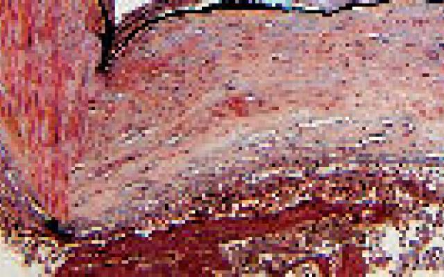 Vaker aneurysma hersenen bij afwijking aortaklep