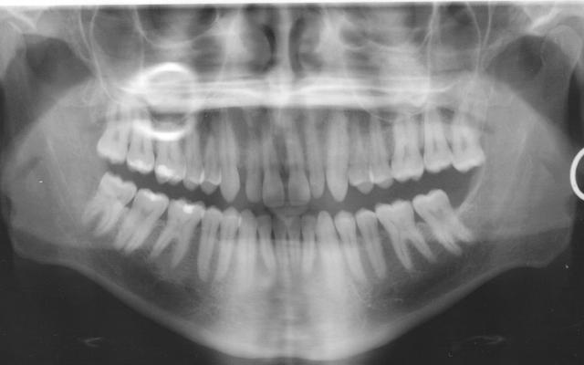 Tandheelkundige röntgenfoto vergroot risico schildklierkanker