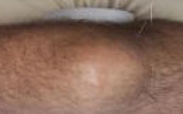 Ook nepacupunctuur werkt bij knieartrose