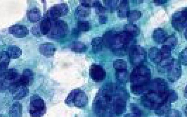 Gemcitabine niet beter dan fluorouracil na operatie alvleesklierkanker