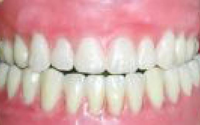 Toezicht op implementeren richtlijn mondzorg heeft nauwelijks effect