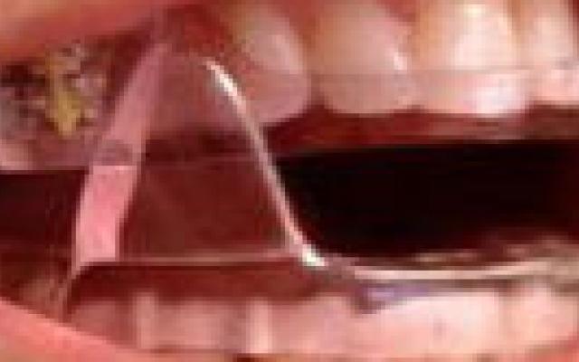 Beugel toch effectief bij slaapapneu