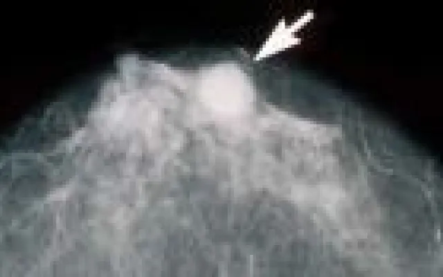 Het verschil zit voornamelijk in de tumor