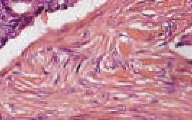 Patiënten prefereren micrografische chirurgie basalioom