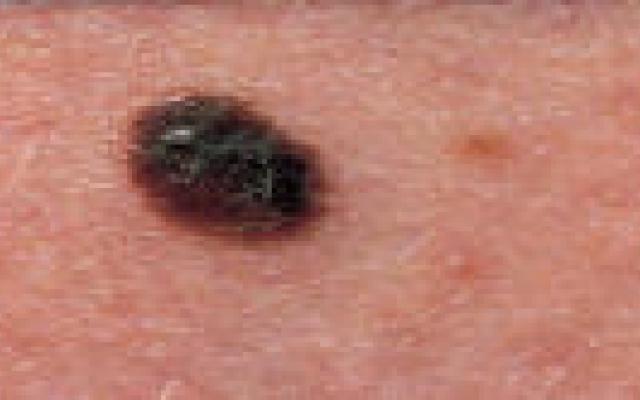 Volgen van hoogrisicopatiënten op melanomen effectief