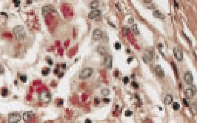 Peginterferon werkt tegen hepatitis D-virus