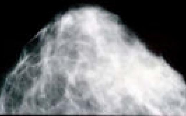 Volume heeft beperkt effect op ontdekken borstkanker