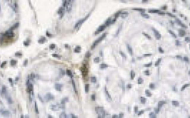 Bijna 1 op de 6 extreme vroeggeboorten door chlamydia