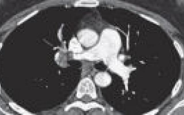CT-angiografie sluit ook bij vrouwen coronairlijden betrouwbaar uit
