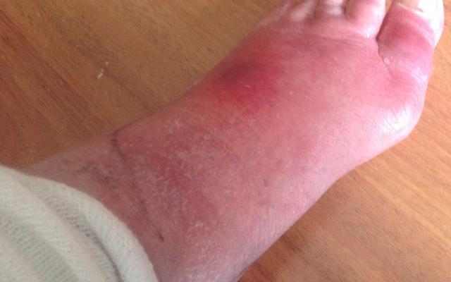 foto van de linkervoet