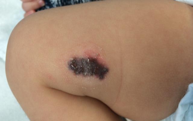 foto van het bovenbeen