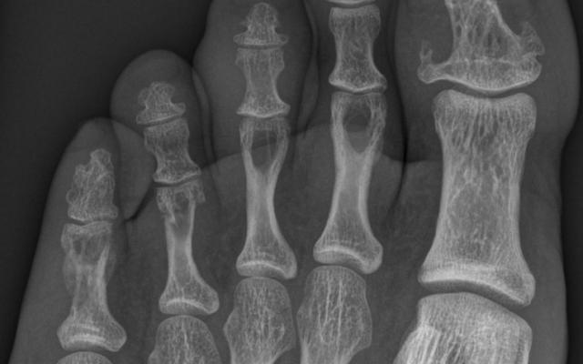 röntgenfoto van de linker voet 
