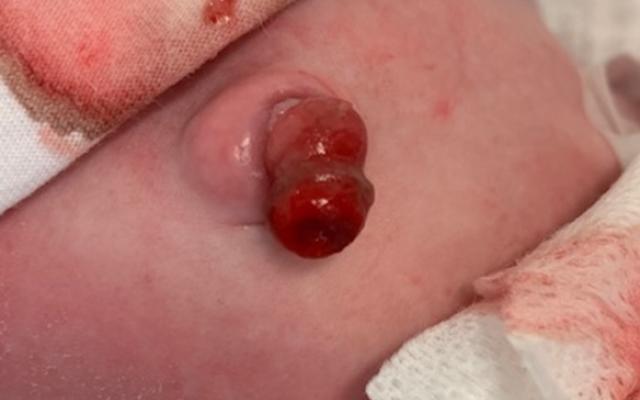 weefsel uit de navel