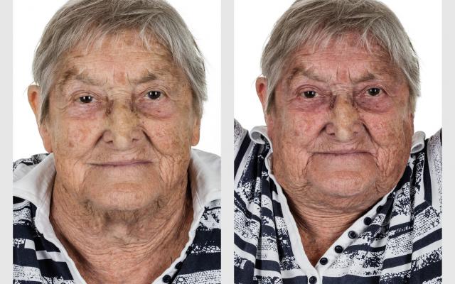 een rood en gezwollen gelaat 