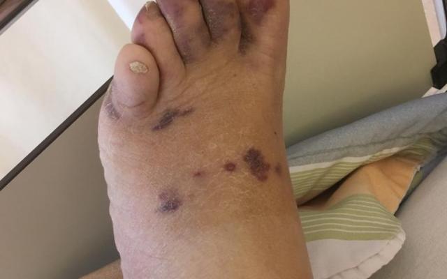 roodpaarse huidafwijkingen