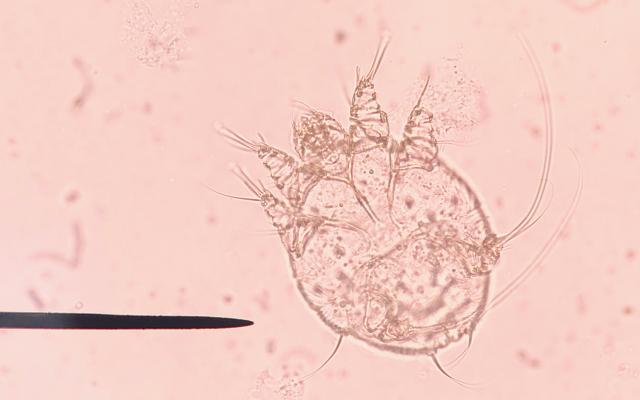 Microscopisch beeld van scabiës.