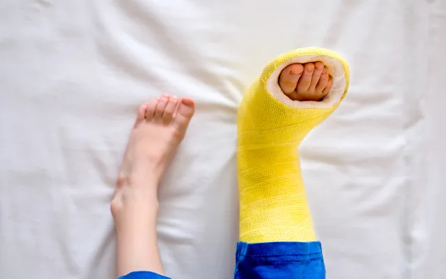 Een paar voeten waarvan de rechter voet in het gips zit.