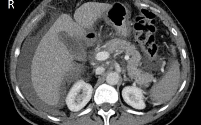 Axiale CT-scan van de bovenbuik in de portaal-veneuze fase.