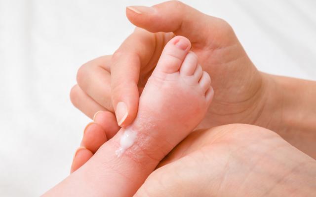 Een hand smeert zalf over de kleine voet van een kind.