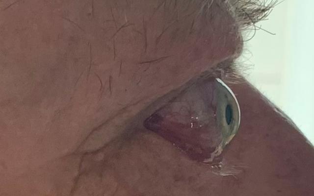 Een man met uitpuilende ogen.