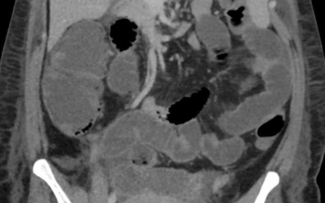 Een CT-scan van het abdomen.